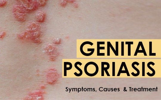 Genital Psoriasis - (Symptoms, Causes and Treatment)