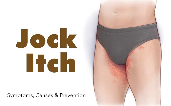Jock Itch - (Symptoms, Causes & Prevention)