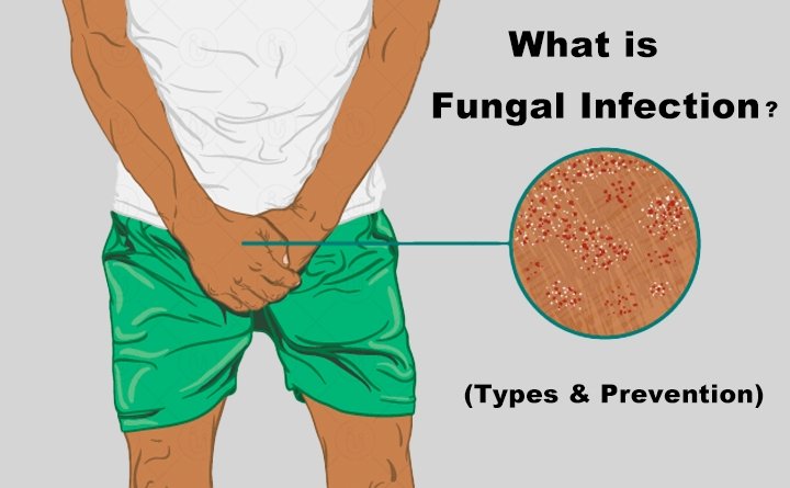Fungal Infection (Types & Prevention) - Nuutjob